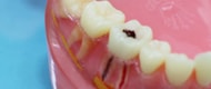 奥歯の虫歯